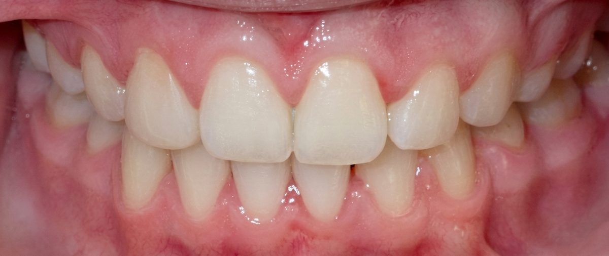 Vivid Smiles patient case 10 before and after treatment comparison after